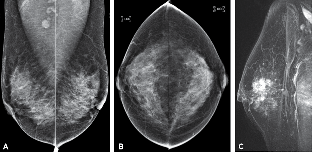 IDC in a 42-year-old woman. Bilateral MLO (a) and craniocaudal (b) screening DM images